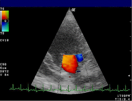 ملف:Doppler mitral valve.gif