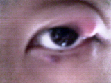 Chalazion25pc.jpg