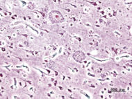 Alzheimer dementia (3) presenile onset.jpg