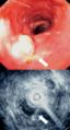 Mid esophageal mass