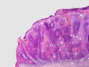 SkinTumors-P6190325.JPG