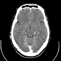 Computed tomography of brain of Mikael Häggström (12).png