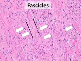 Fascicular: Generally the same cell type throughout, but some form band-like groups that are aligned in the same direction.
