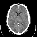 Computed tomography of brain of Mikael Häggström (16).png