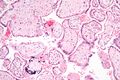 Micrograph of CMV placentitis.