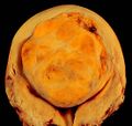 A relatively large submucosal leiomyoma; it fills out the major part of the endometrial cavity