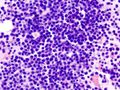 Bone marrow aspirate showing the histologic correlate of multiple myeloma under the microscope. H&E stain.
