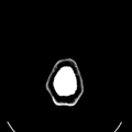 Computed tomography of brain of Mikael Häggström (33).png