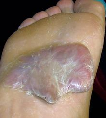Keloid-01.jpg