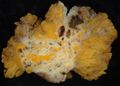 Endometriosis, abdominal wall