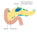 Involvement of nearby lymph nodes – Stage N1
