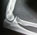 X-ray of the lipoma.