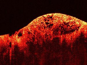 Nibib 030207 105309 sarcoma.jpg