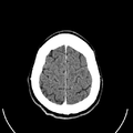 Computed tomography of brain of Mikael Häggström (27).png