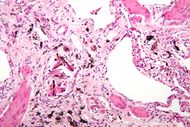 Asbestosis high mag.jpg