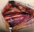 The operating field after removal of the lipoma. Arrow marks the median nerve which was compressed by the lipoma.
