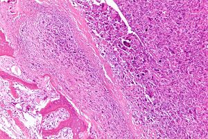 Osteosarcoma - intermed mag.jpg