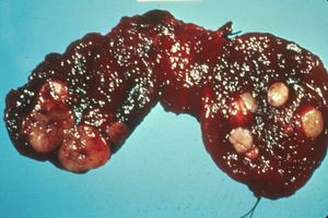 Human thyroid cancer.jpg