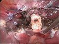 cervical stump (white) after removement of the uterine corpus at laparoscopic supracervical hysterectomy