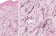 Histopathology of linear focal elastosis.jpg