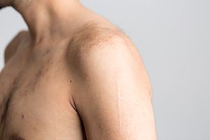 Left shoulder.jpg