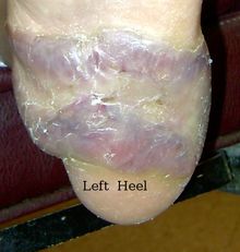Keloid-02.jpg
