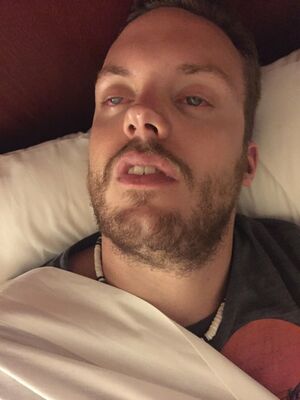 Nocturnal lagophthalmos.jpg