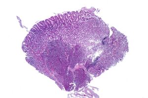 Stomach with pancreatic heterotopia, low mag.2.jpg