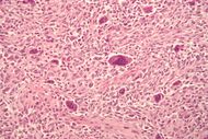 Osteosarcoma.jpg