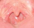 Soft palate without tonsils (after tonsillectomy)