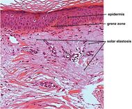 Micrograph of solar elastosis.jpg