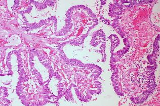 Papillary: Protuberances of epithelioid cells around fibrovascular cores.