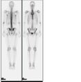 A nuclear medicine whole body bone scan. The nuclear medicine whole body bone scan is generally used in evaluations of various bone-related pathology, such as for bone pain, stress fracture, nonmalignant bone lesions, bone infections, or the spread of cancer to the bone.