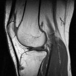Knee MR