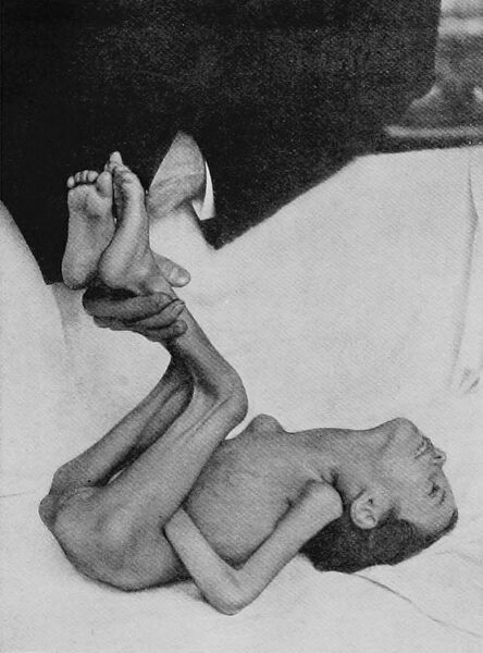 ملف:Kernig's sign cerebrospinal meningitis.jpg