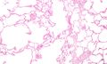 Micrograph demonstrating emphysema (left of image - large empty spaces) and lung tissue with relative preservation of the alveoli (right of image). H&E stain.