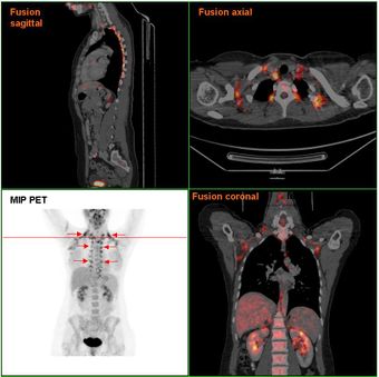 Brownfat PETCT.jpg