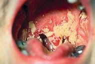 230px-Oral thrush Aphthae Candida albicans. PHIL 1217 lores.jpg