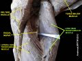 Long head triceps brachii muscle (shown in green text)