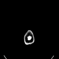 Computed tomography of brain of Mikael Häggström (34).png
