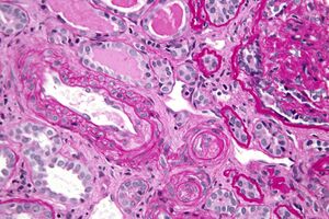Thrombotic microangiopathy - very high mag.jpg