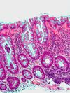Hyperplastic polyp1.jpg