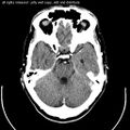 Computed tomography of head, with cerebellum visible at lower part