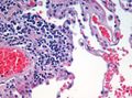 H&E (haematoxylin and eosin) stained lung tissue sample from an end-stage emphysema patient. RBCs are red, nuclei are blue-purple, other cellular and extracellular material is pink, and air spaces are white.