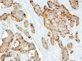 Pancreatic insulinoma (3) Chromogranin A.JPG