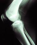 Knee X-ray