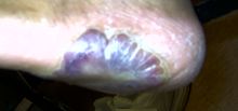 Keloid-03.jpg