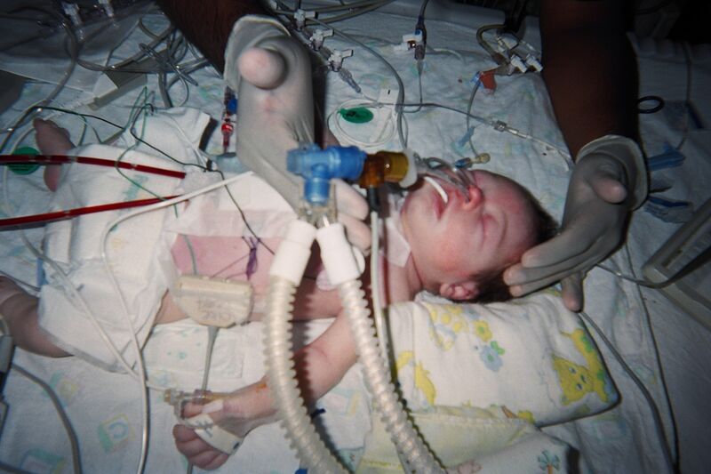 ملف:Postop Jatene neonate.jpg