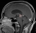 Tumor Pineocytoma3.JPG