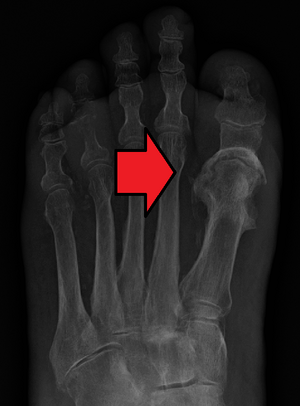 OsteomylitisMark.png